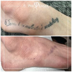 odstranjevanje tetovaže na nogi