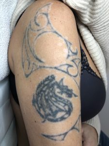neustrezno odstranjevanje tetovaže