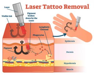 laserska odstranitev tetovaže
