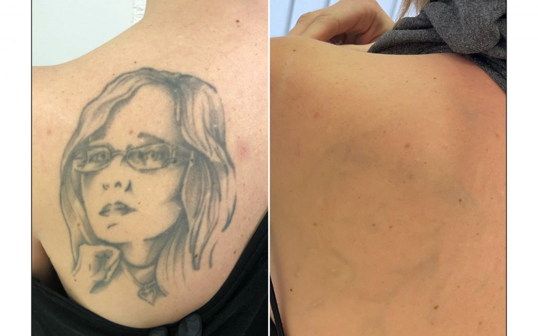 Odstranjevanje tetovaž brez brazgotin Maribor